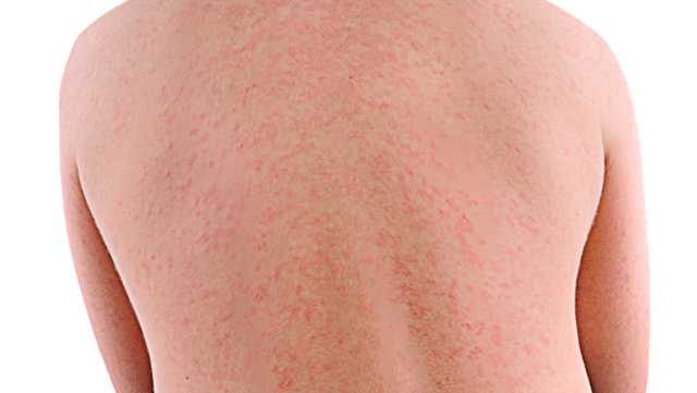Fourth measles case of 2025 confirmed in South Carolina