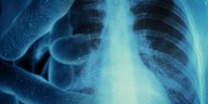 Legionnaires’ disease cases rise to 70 in Marshall County, officials say