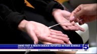 Hand, Foot and Mouth Disease reported at...