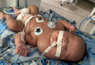 Madre solicita ayuda para bebé que nació con tumor líquido en el cuello