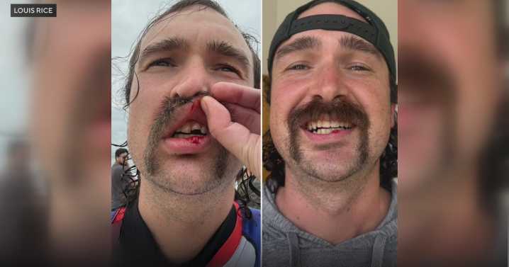 Huntington Beach dentist helps Marine veteran who broke tooth while surfing