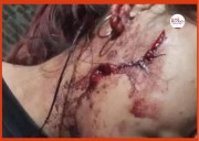 Grave agresión en Presidencia de la Plaza: joven sufrió cortes en el rostro por su expareja