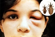 Deadly 'kissing bug' parasite is now in 30 US states