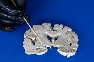 Impulsan Museo del Cerebro para sensibilizar sobre enfermedades neurodegenerativas