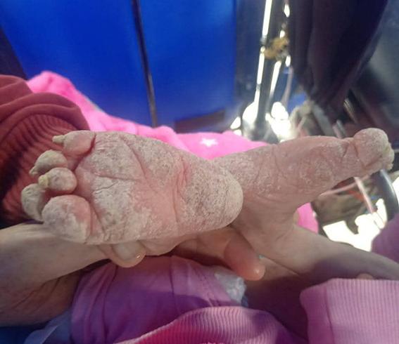 Bebé de 1 año 5 meses lucha contra enfermedad llamada “Piel de Mariposa”