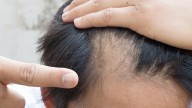 Cuatro personas a juicio por administrar minoxidil en lugar de omeprazol