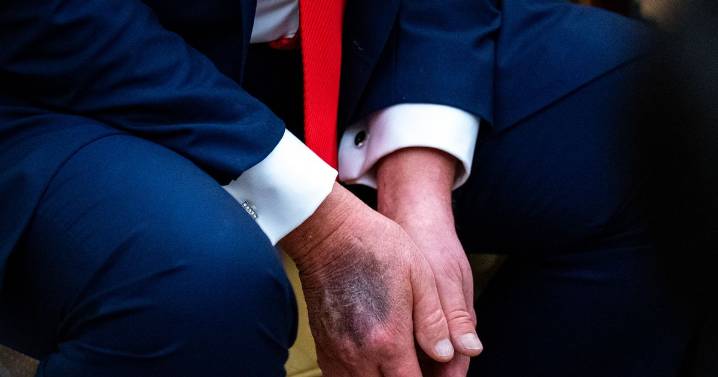 Vascular surgeon explains warning signs a 'Trump bruise' is serious