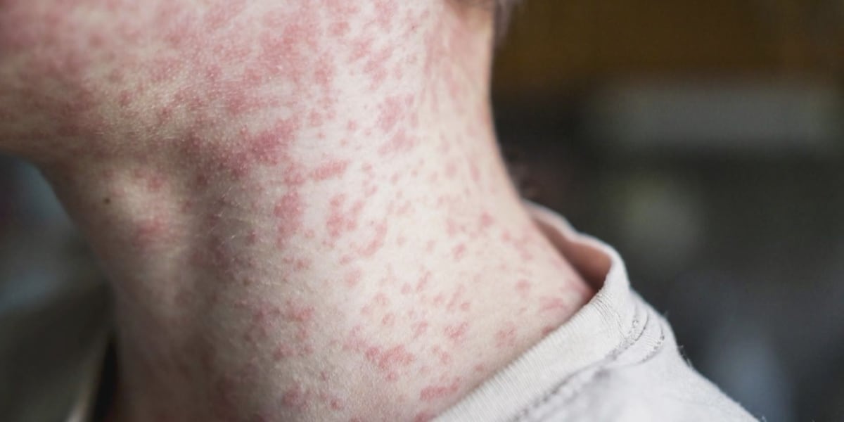 Virginia confirms 4th measles case of 2025 after child’s international travel