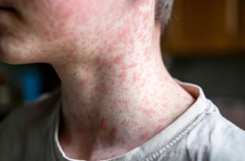 Epidemiología provincial intensifica vigilancia ante brote de sarampión en Paraguay