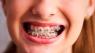 La ANMAT prohibió la venta de brackets por riesgo a la salud