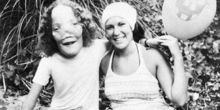 El joven que vivió con una enfermedad rara que deformaba su cráneo e inspiró a Hollywood: “No me recuerden por mi cara”