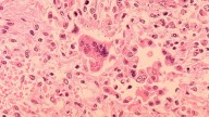 Los Angeles County child dies of rare measles complication years after infection