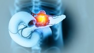 Fumar apaga las defensas y enciende el cáncer de páncreas