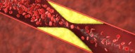 Half of Heart Attacks in Younger Women Aren't From Clogged Arteries