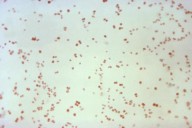 Sexually transmitted disease cases fall, but not syphilis in newborns