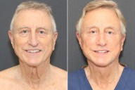 Man, 70, Gets Facelift After Retiring to Bring 'Magic' into His Life. See the Before