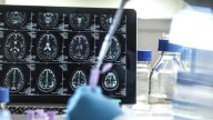 NHS not ready for new era of diagnosing and treating Alzheimer's disease