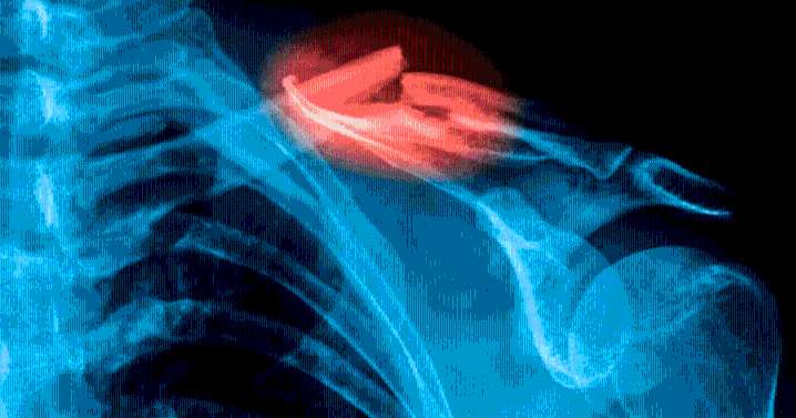 Científicos desarrollan una 'pistola de pegamento' 3D para imprimir injertos óseos y reparar fracturas en cirugías