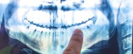 The Cause of Alzheimer's Could Be Coming From Within Your Mouth