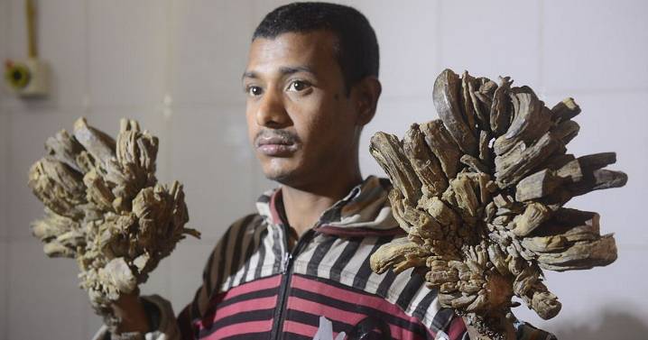 'Tree-man' syndrome where incurable condition causes agony and bark