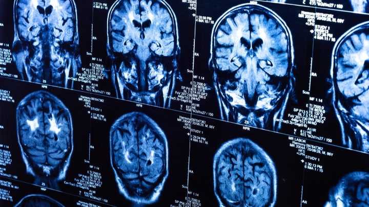 Día del Neurólogo Peruano: guardianes del cerebro y la salud del sistema nervioso
