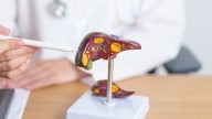 Hígado graso: cómo prevenir una enfermedad con impacto en la salud cardiovascular