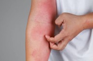 Dermatitis Atópica, hasta un año para ser diagnosticada 