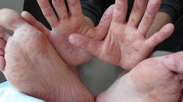 Desmienten brote de virus coxsackie en Morelos