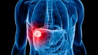 Descubren una nueva estrategia contra un cáncer de hígado más agresivo