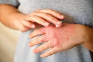 Día Mundial de la Dermatitis Atópica: causas y tratamientos