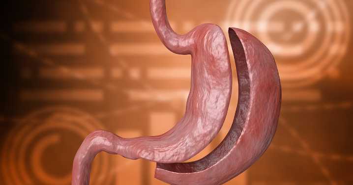 Bariatric surgery ‘provides added, durable benefits’ beyond GLP