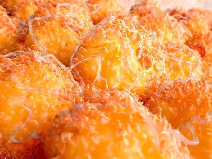 Fat Location, Not Just BMI, Influences Risk of 12 Cancers
