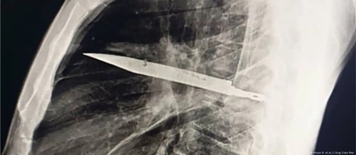 Hombre vive 8 años con un cuchillo en el tórax sin saberlo