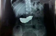 Increíble hazaña médica: logran rescatar a una niña tras tragar 134 peligrosas bolas magnéticas