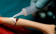 Científicos chinos crean un pegamento para huesos que repara fracturas en solo tres minutos de forma rápida y segura