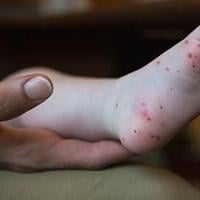 Hamilton County sees uptick in Hands, Foot, and Mouth Disease as kids return to school