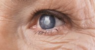 Multifocal IOLs reduce spectacle use in mild, moderate glaucoma