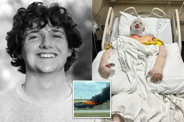 Texas college student suffers 'catastrophic' burns after being struck by alleged drunk driver