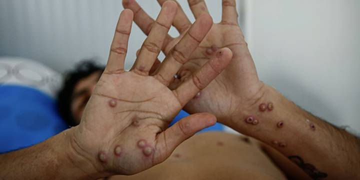 OMS levanta la emergencia internacional por el virus mpox, pero señaló que la alerta sigue vigente