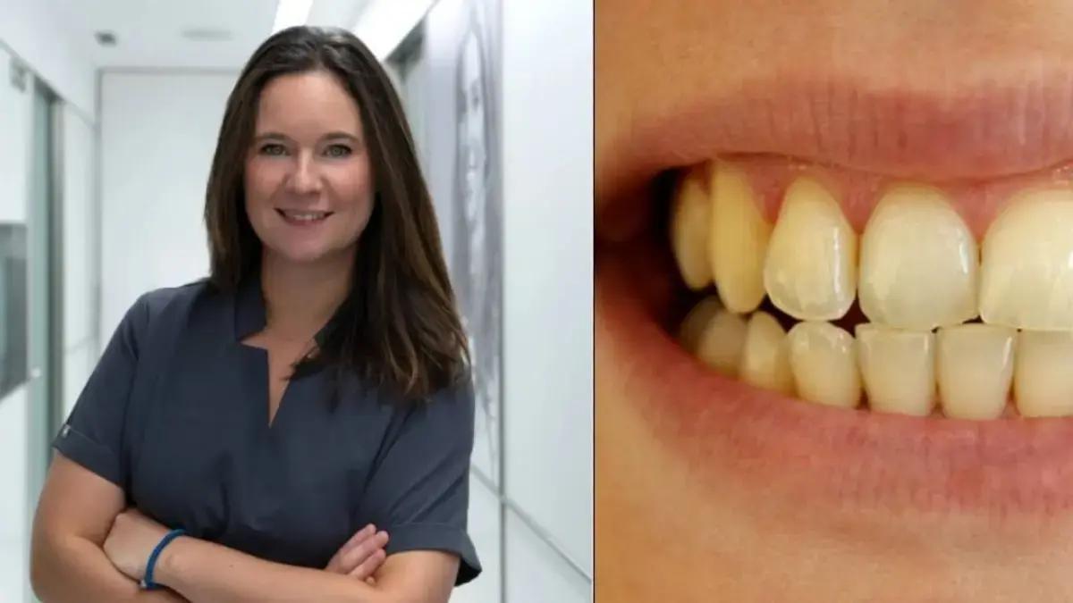 ¿Por qué se ponen los dientes amarillos y cómo se puede evitar? Según ortodoncista
