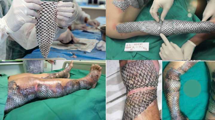 Piel de tilapia: Un innovador tratamiento alternativo para quemaduras que revoluciona la m...
