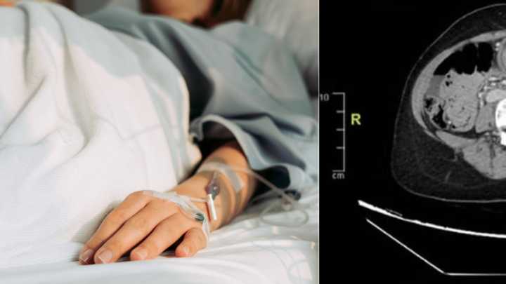 Adolescente con trastorno de 'pica' le extraen una bola de pelo gigante del estómago: llegó al hospital con dolor abdominal intenso