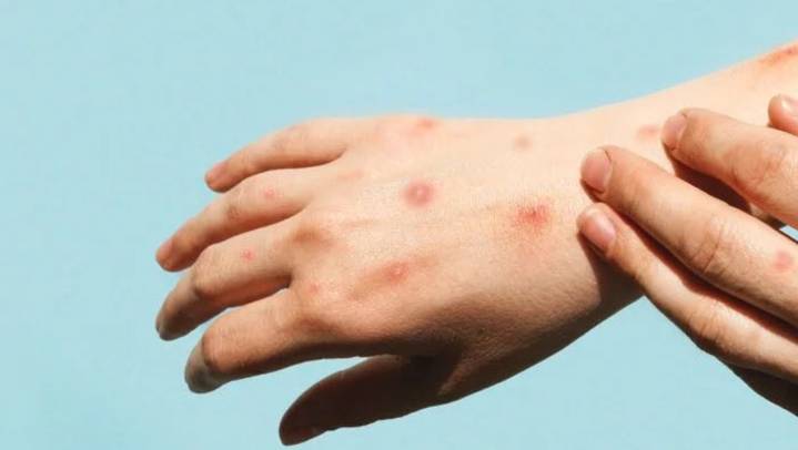 Mpox se dispara 860% en México: AHF alerta en día mundial de la salud sexual