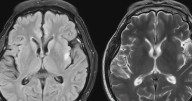 New study on CTE seeks living athletes' data to improve diagnosis, treatment