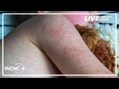 South Carolina measles update: 4th case of 2025 confirmed in Upstate