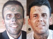 Man with tattoos on 95% of his body shares removal process