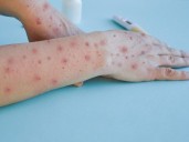 OMS declara el fin de la emergencia sanitaria internacional por viruela del mono, pero mantiene la alerta en África