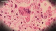Virginia confirms fourth measles case in 2025 with child in Hampton Roads
