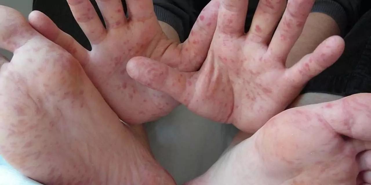 Detectan casos del virus Coxsackie en escuela primaria de Juchitán