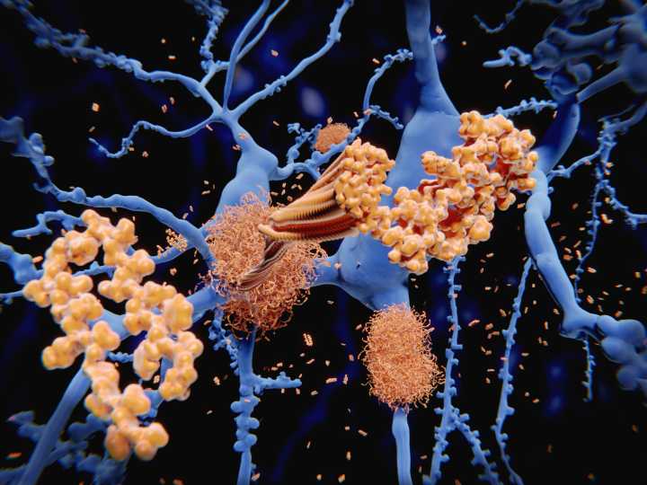 Fiber-Optic Method Allows Longitudinal Study of Alzheimer’s Pathology